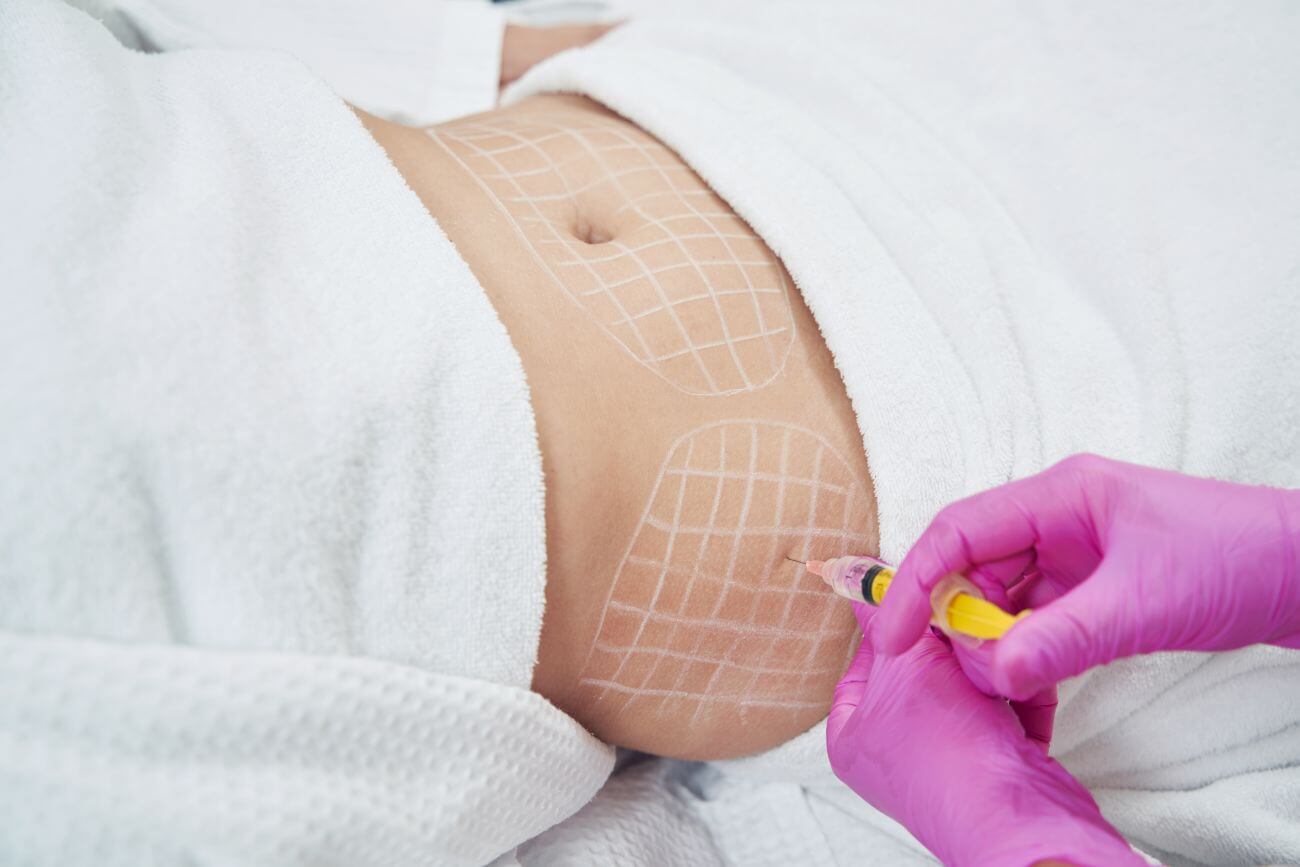 liposukcja ultradźwiękowa